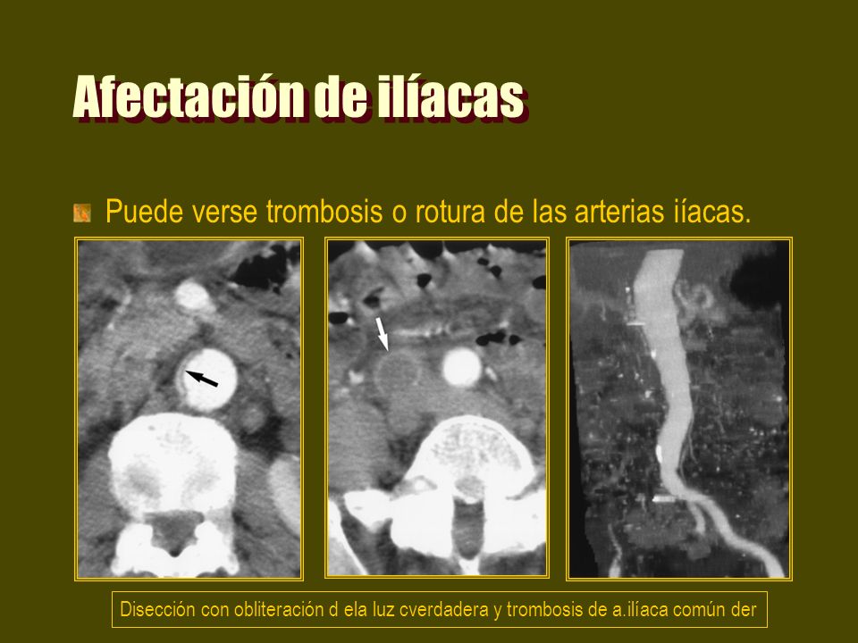 Afectación de ilíacas Puede verse trombosis o rotura de las arterias iíacas.