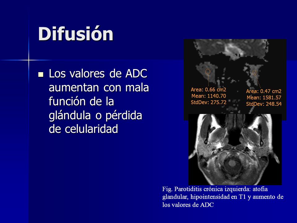 Difusión Los valores de ADC aumentan con mala función de la glándula o pérdida de celularidad.