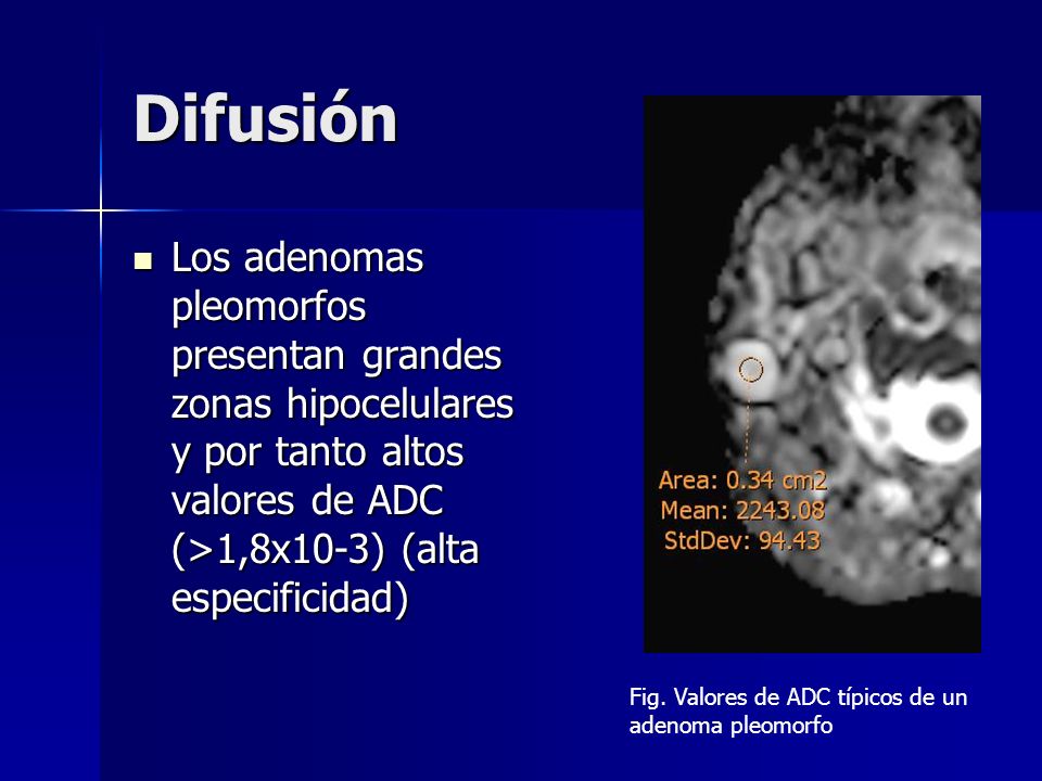 Difusión Los adenomas pleomorfos presentan grandes zonas hipocelulares y por tanto altos valores de ADC (>1,8x10-3) (alta especificidad)