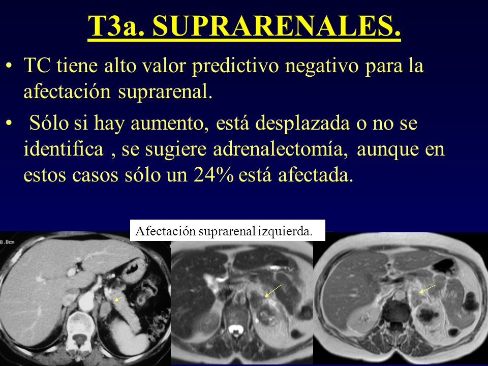 T3a. SUPRARENALES. TC tiene alto valor predictivo negativo para la afectación suprarenal.