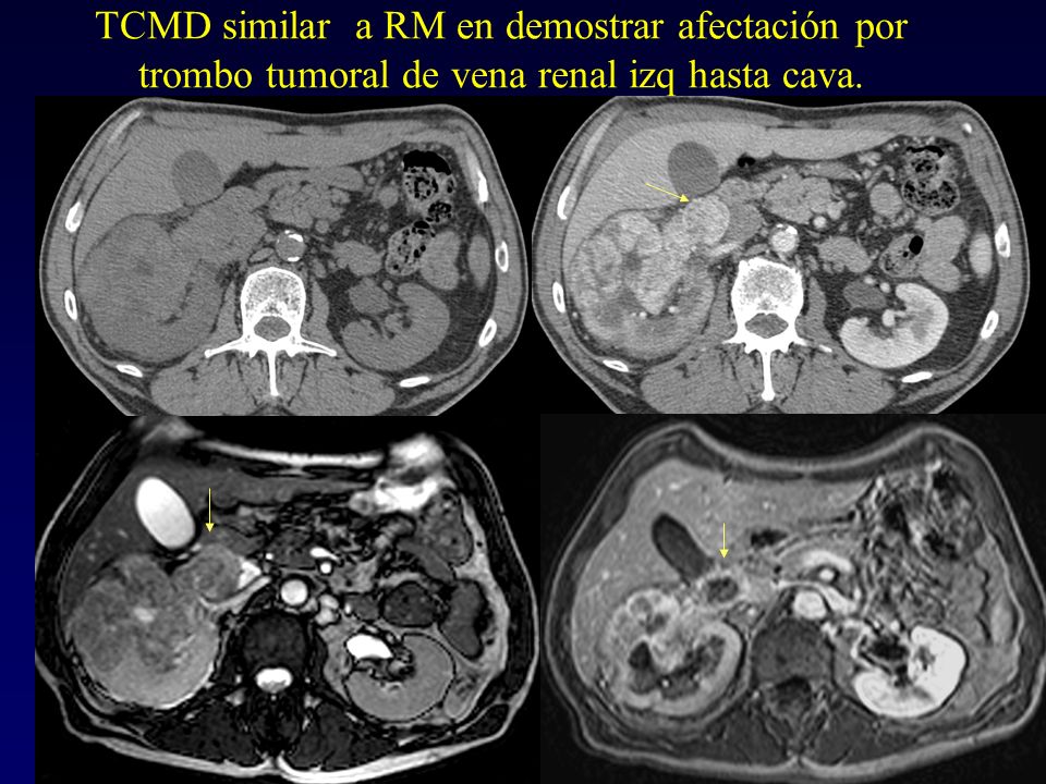 TCMD similar a RM en demostrar afectación por trombo tumoral de vena renal izq hasta cava.