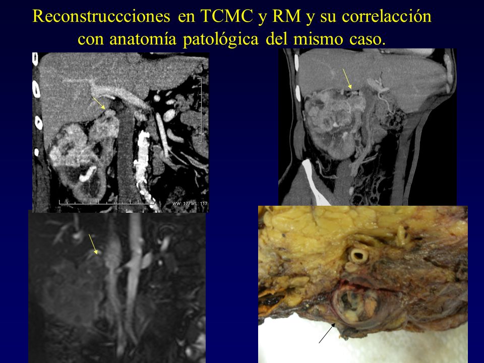 Reconstruccciones en TCMC y RM y su correlacción con anatomía patológica del mismo caso.