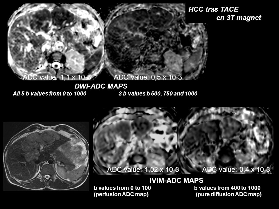 ADC value: 1,1 x 10-3 ADC value: 0,5 x 10-3 DWI-ADC MAPS