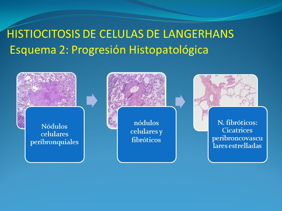 HISTIOCITOSIS DE CELULAS DE LANGERHANS Esquema 2: Progresión Histopatológica