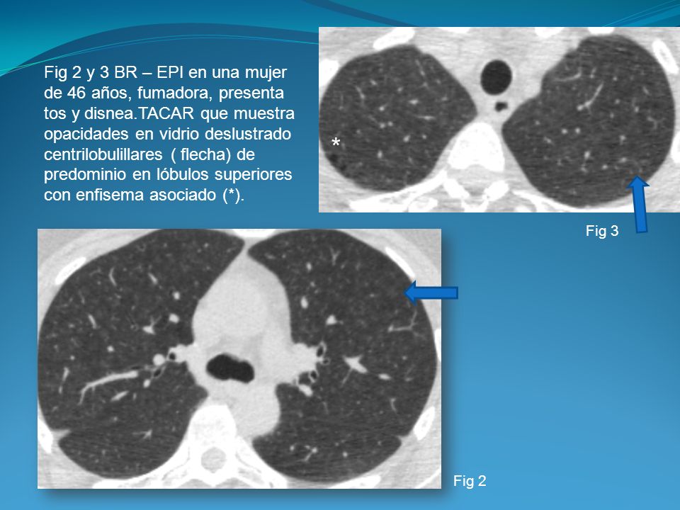 Fig 2 y 3 BR – EPI en una mujer de 46 años, fumadora, presenta tos y disnea.TACAR que muestra opacidades en vidrio deslustrado centrilobulillares ( flecha) de predominio en lóbulos superiores con enfisema asociado (*).