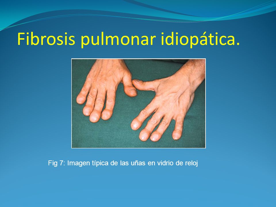 Fibrosis pulmonar idiopática.