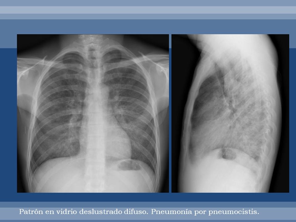 Patrón en vidrio deslustrado difuso. Pneumonía por pneumocistis.