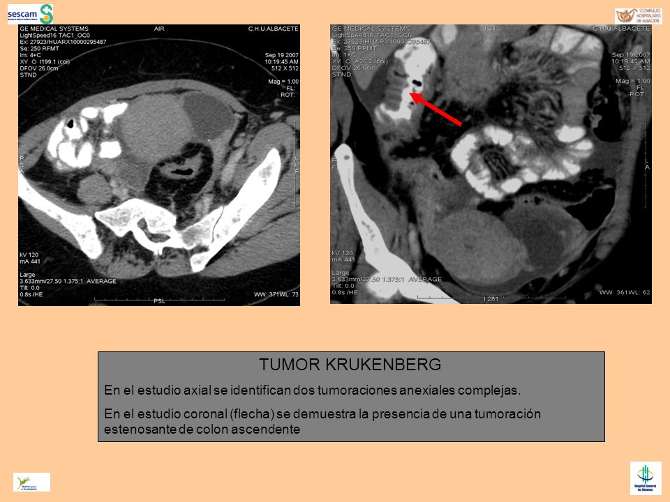 TUMOR KRUKENBERG En el estudio axial se identifican dos tumoraciones anexiales complejas.