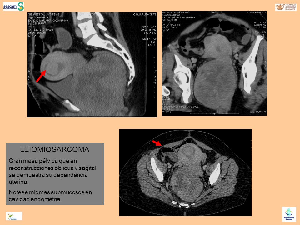 LEIOMIOSARCOMA Gran masa pélvica que en reconstrucciones oblicua y sagital se demuestra su dependencia uterina.