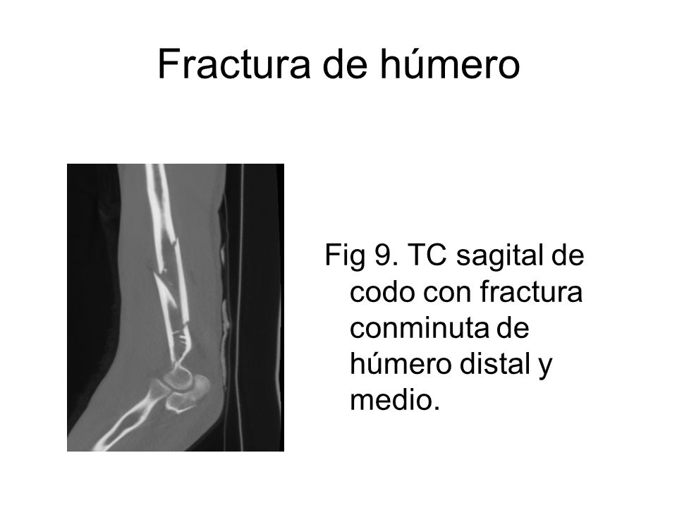 Fractura de húmero Fig 9. TC sagital de codo con fractura conminuta de húmero distal y medio.