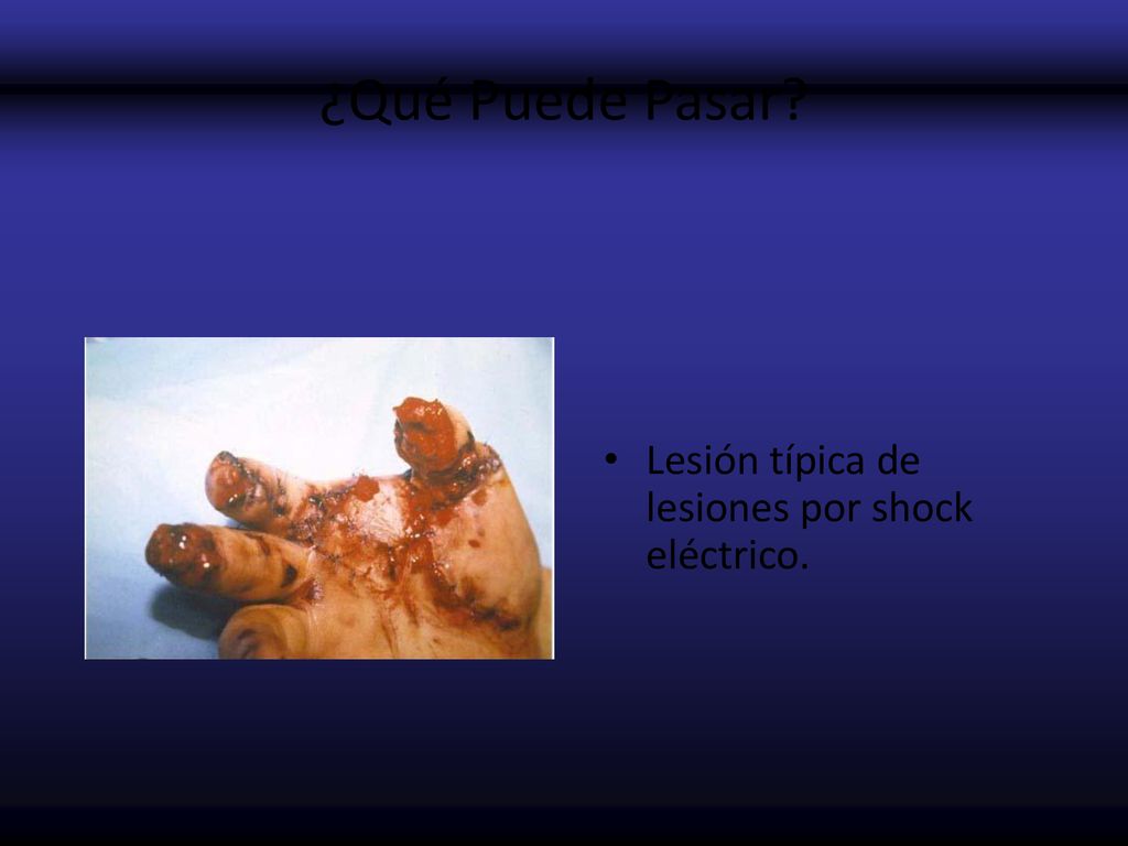 ¿Qué Puede Pasar Lesión típica de lesiones por shock eléctrico.