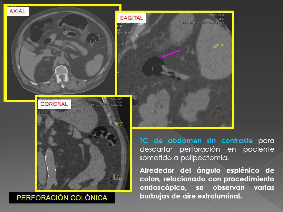 AXIAL SAGITAL. CORONAL. TC de abdomen sin contraste para descartar perforación en paciente sometido a polipectomía.