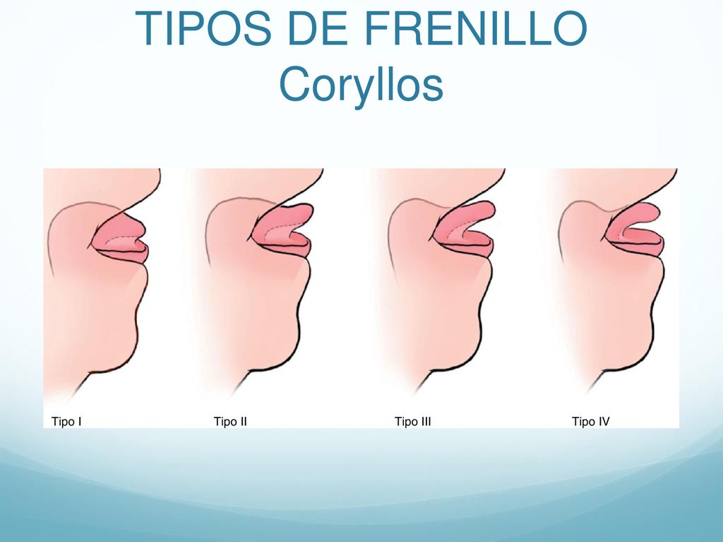 TIPOS DE FRENILLO Coryllos