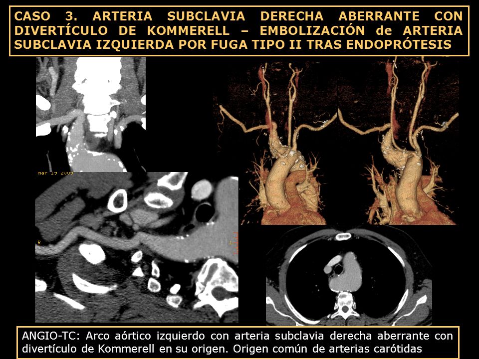 CASO 3. ARTERIA SUBCLAVIA DERECHA ABERRANTE CON DIVERTÍCULO DE KOMMERELL – EMBOLIZACIÓN de ARTERIA SUBCLAVIA IZQUIERDA POR FUGA TIPO II TRAS ENDOPRÓTESIS