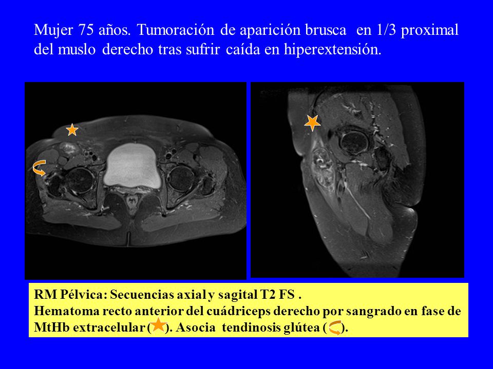 Mujer 75 años. Tumoración de aparición brusca en 1/3 proximal del muslo derecho tras sufrir caída en hiperextensión.