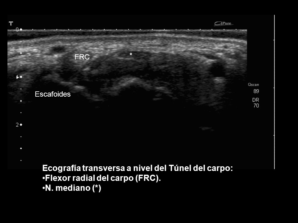 * Ecografía transversa a nivel del Túnel del carpo: