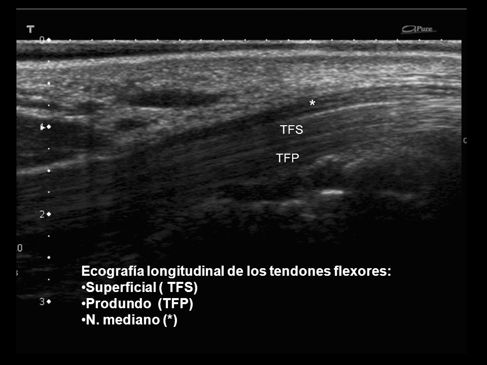 * Ecografía longitudinal de los tendones flexores: Superficial ( TFS)
