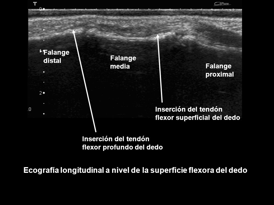 Ecografía longitudinal a nivel de la superficie flexora del dedo