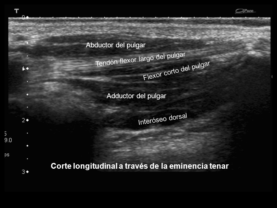 Corte longitudinal a través de la eminencia tenar