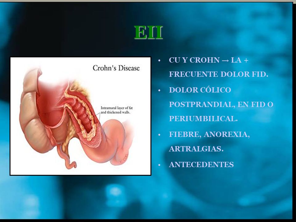 EII CU Y CROHN → LA + FRECUENTE DOLOR FID.