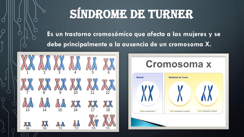 Síndrome de TURNER Es un trastorno cromosómico que afecta a las mujeres y se debe principalmente a la ausencia de un cromosoma X.