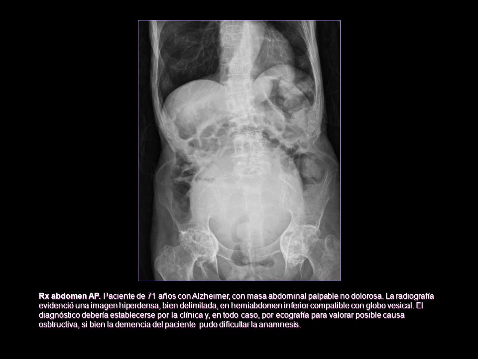 Rx abdomen AP. Paciente de 71 años con Alzheimer, con masa abdominal palpable no dolorosa.