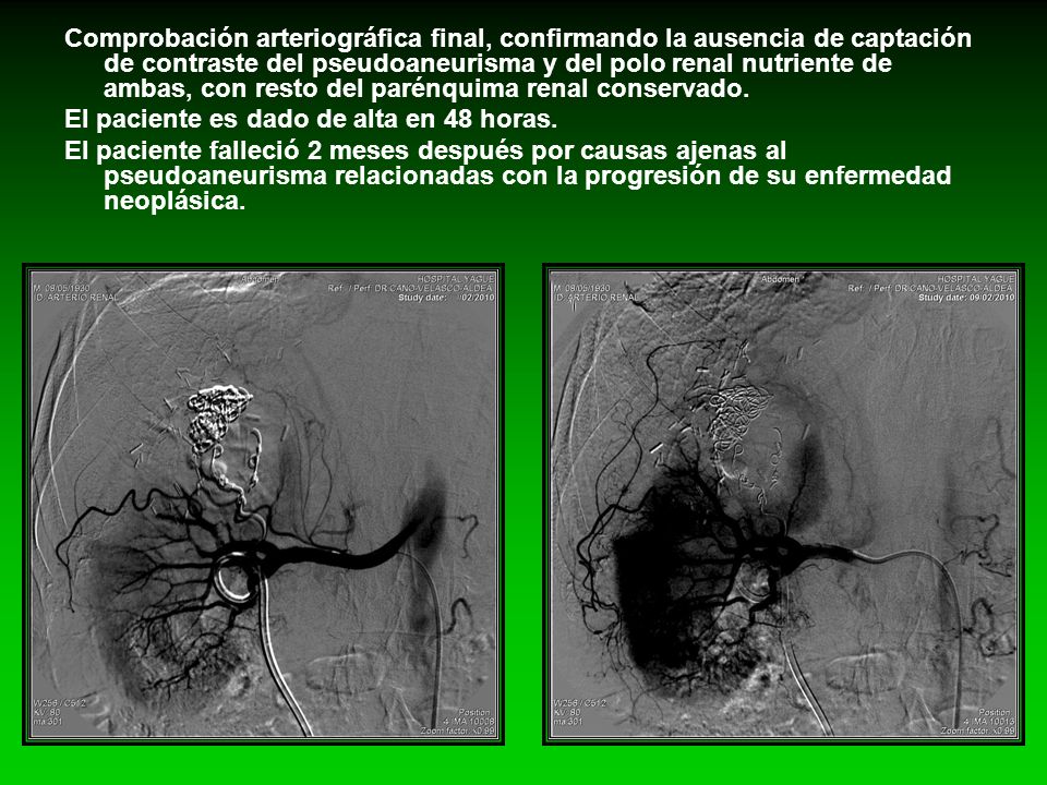 Comprobación arteriográfica final, confirmando la ausencia de captación de contraste del pseudoaneurisma y del polo renal nutriente de ambas, con resto del parénquima renal conservado.