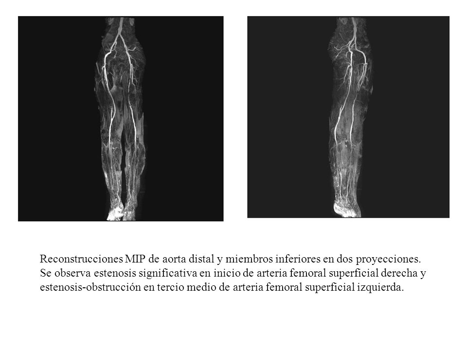 Reconstrucciones MIP de aorta distal y miembros inferiores en dos proyecciones.