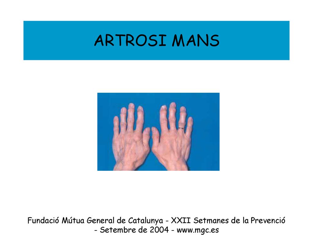 ARTROSI MANS Fundació Mútua General de Catalunya - XXII Setmanes de la Prevenció - Setembre de