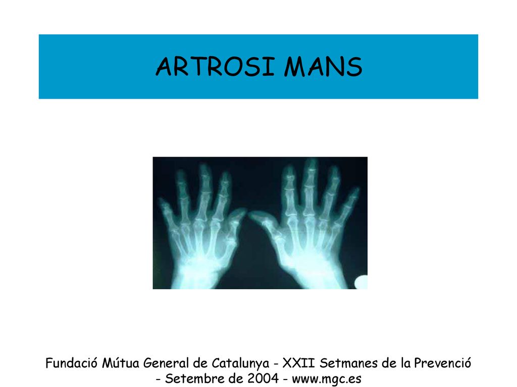 ARTROSI MANS Fundació Mútua General de Catalunya - XXII Setmanes de la Prevenció - Setembre de