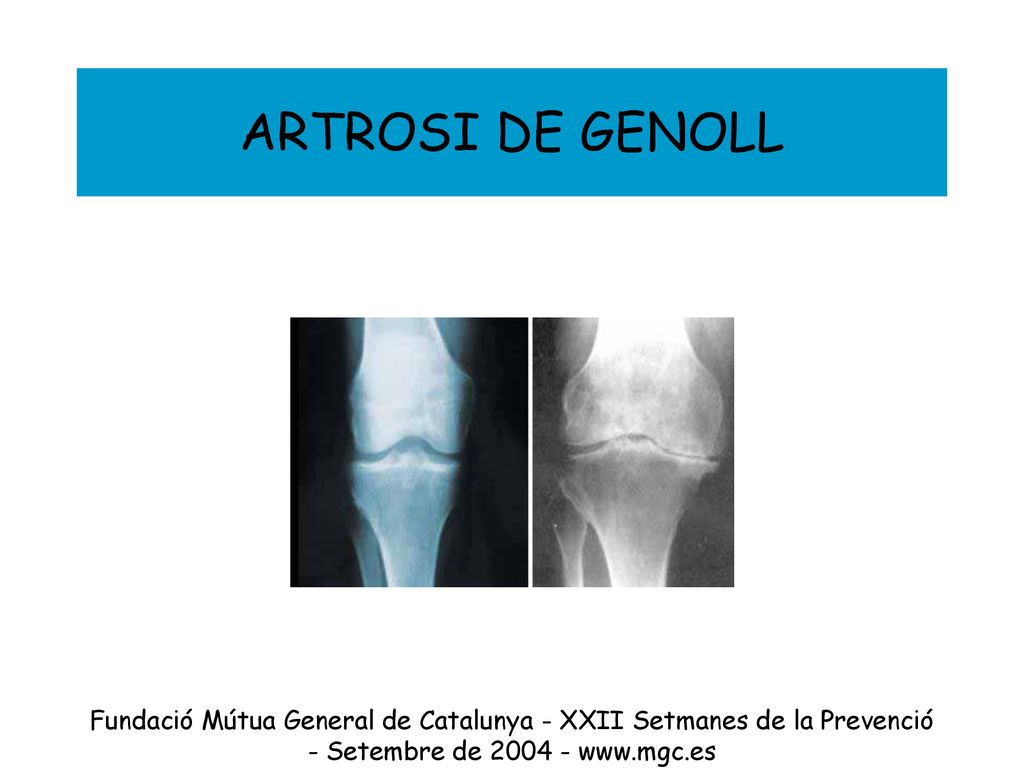 ARTROSI DE GENOLL Fundació Mútua General de Catalunya - XXII Setmanes de la Prevenció - Setembre de
