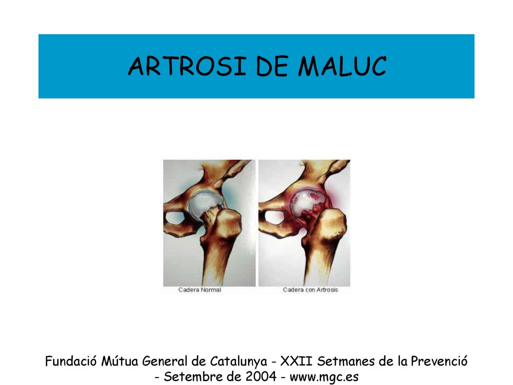 ARTROSI DE MALUC Fundació Mútua General de Catalunya - XXII Setmanes de la Prevenció - Setembre de