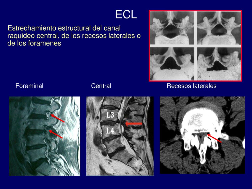 ECL Estrechamiento estructural del canal raquideo central, de los recesos laterales o de los foramenes.