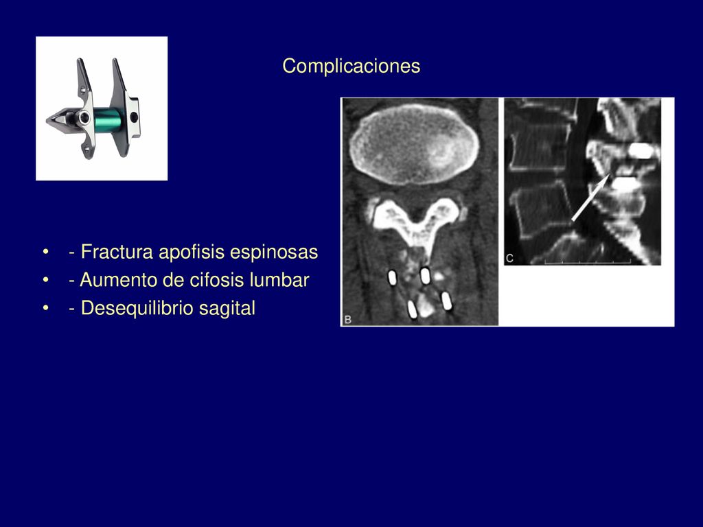 Complicaciones - Fractura apofisis espinosas - Aumento de cifosis lumbar - Desequilibrio sagital