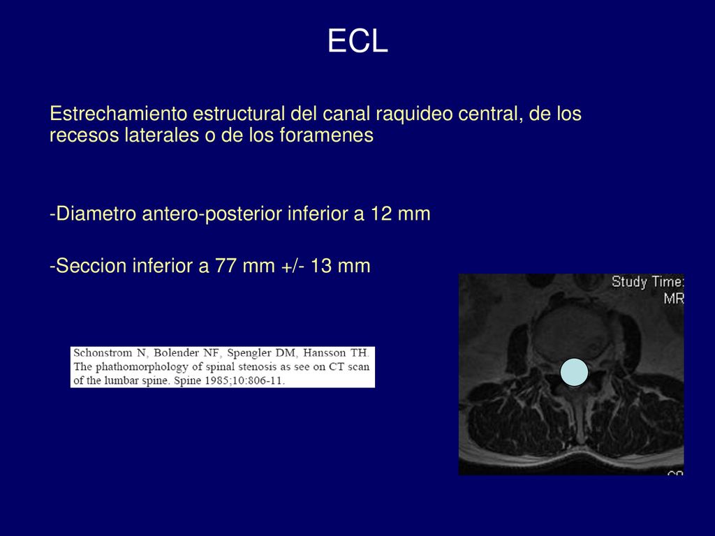 ECL Estrechamiento estructural del canal raquideo central, de los recesos laterales o de los foramenes.