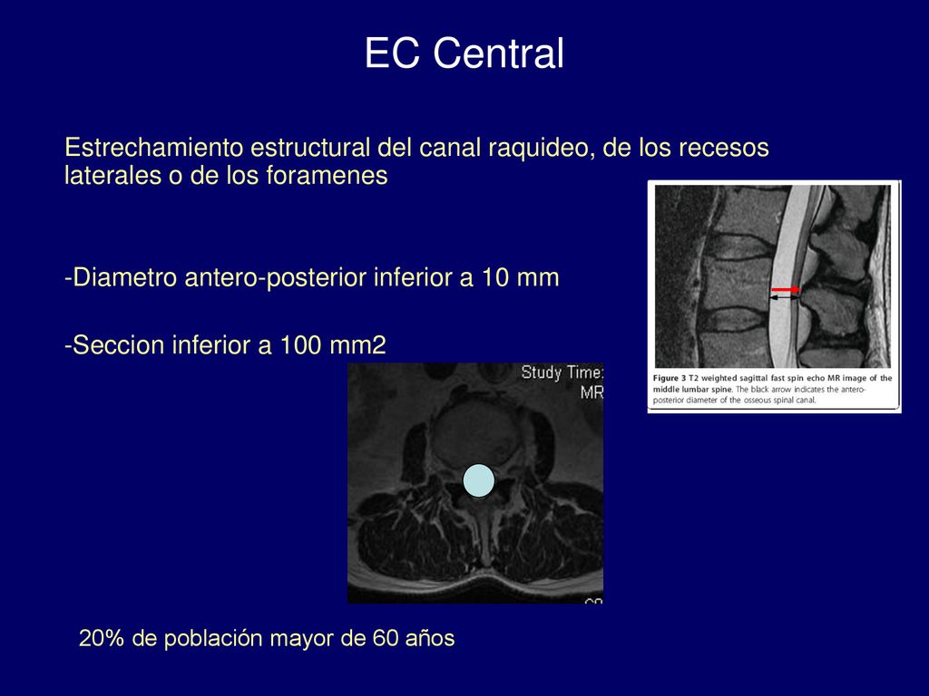 EC Central Estrechamiento estructural del canal raquideo, de los recesos laterales o de los foramenes.