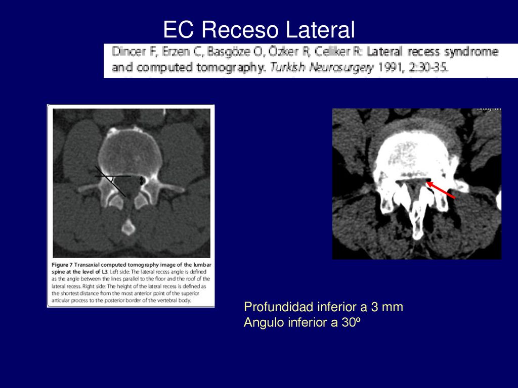 EC Receso Lateral Profundidad inferior a 3 mm Angulo inferior a 30º