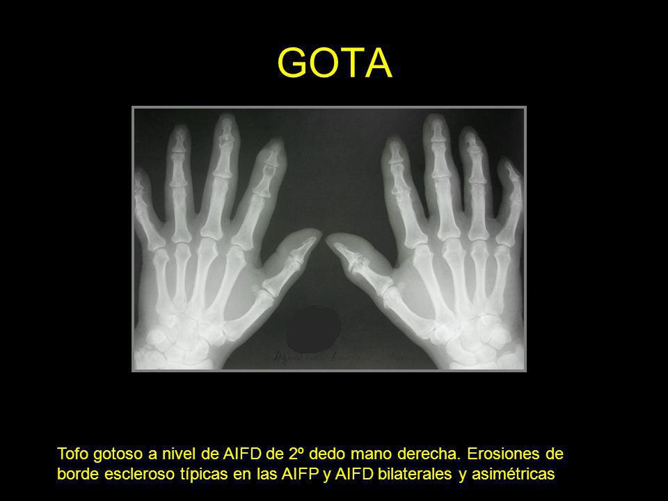 GOTA Tofo gotoso a nivel de AIFD de 2º dedo mano derecha.