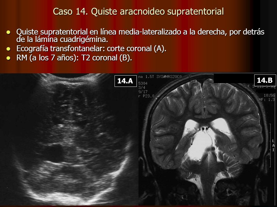 Caso 14. Quiste aracnoideo supratentorial