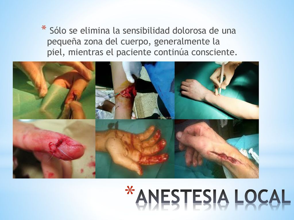 Sólo se elimina la sensibilidad dolorosa de una pequeña zona del cuerpo, generalmente la piel, mientras el paciente continúa consciente.