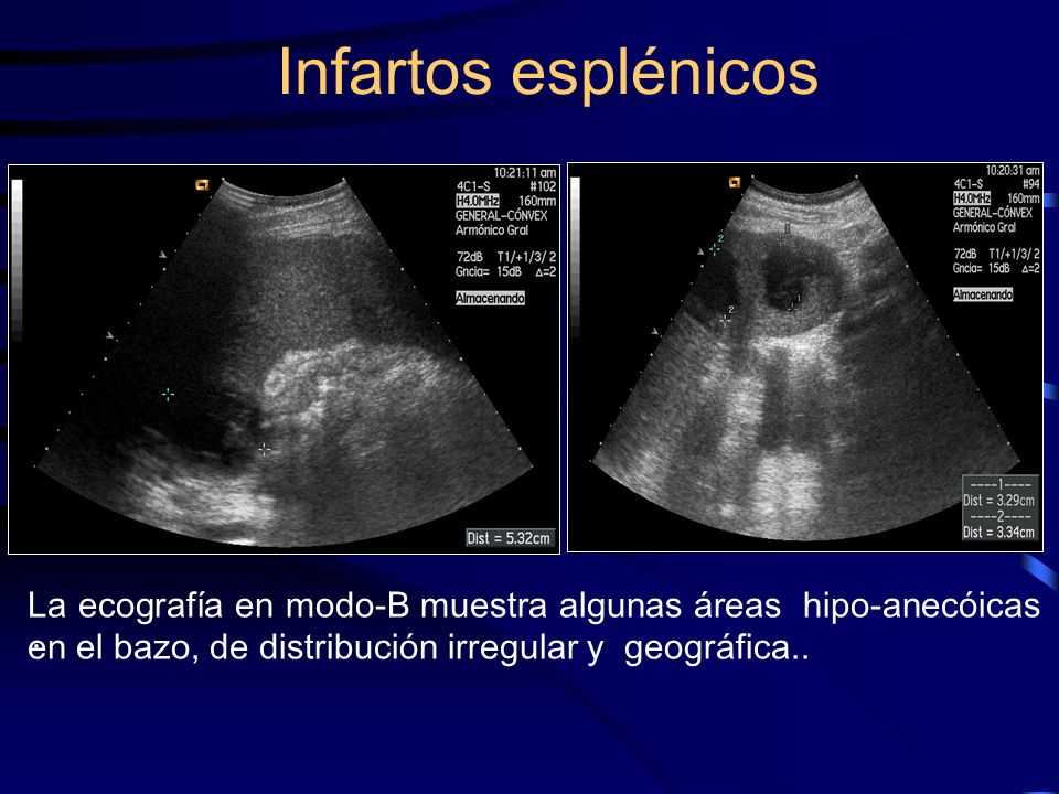 Infartos esplénicos La ecografía en modo-B muestra algunas áreas hipo-anecóicas en el bazo, de distribución irregular y geográfica..