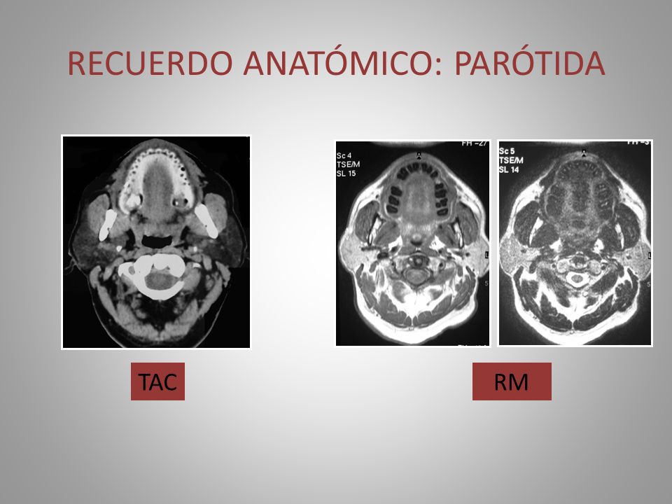 RECUERDO ANATÓMICO: PARÓTIDA