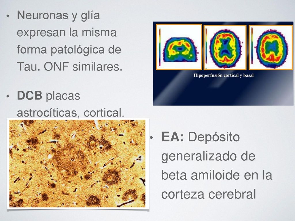 EA: Depósito generalizado de beta amiloide en la corteza cerebral