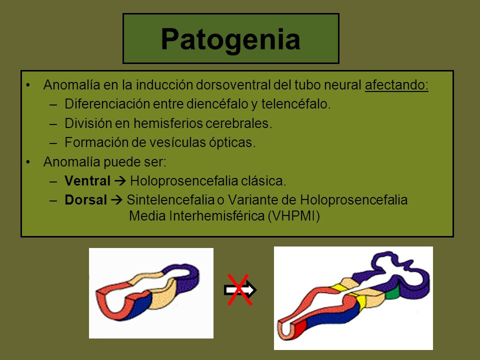Patogenia Anomalía en la inducción dorsoventral del tubo neural afectando: Diferenciación entre diencéfalo y telencéfalo.
