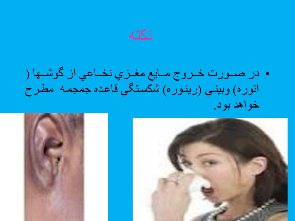 نكته در صورت خروج مايع مغزي نخاعي از گوشها ( اتوره) وبيني (رينوره) شكستگي قاعده جمجمه مطرح خواهد بود.