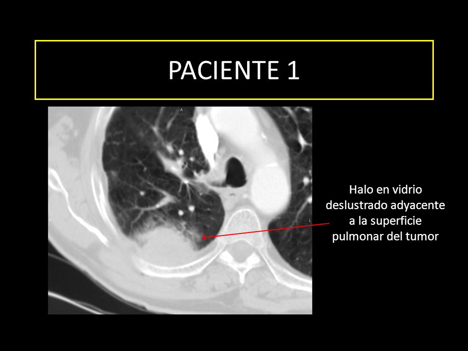 PACIENTE 1 Halo en vidrio deslustrado adyacente a la superficie pulmonar del tumor