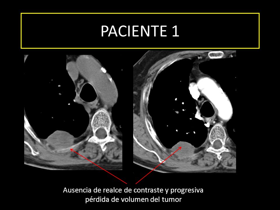 PACIENTE 1 Ausencia de realce de contraste y progresiva pérdida de volumen del tumor