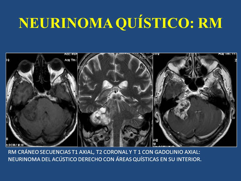 NEURINOMA QUÍSTICO: RM