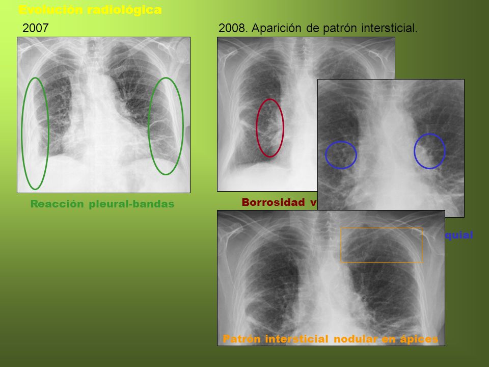Evolución radiológica Aparición de patrón intersticial.