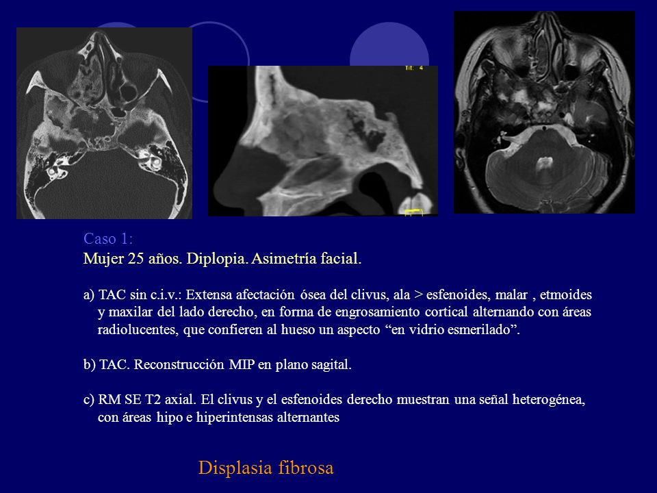 Displasia fibrosa Caso 1: Mujer 25 años. Diplopia. Asimetría facial.
